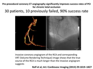 Pre-procedural coronary CT angiography significantly improves success rates of PCI
for chronic total occlusion
30 patients, 10 previously failed, 90% success rate
Rolf et al, Int J Cardiovasc Imaging (2013) 29:1819–1827
Invasive coronary angiogram of the RCA and corresponding
VRT (Volume Rendering Technique) image shows that the true
course of the RCA is much longer than the invasive angiogram
suggests
 