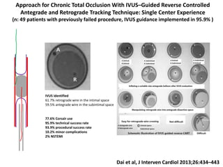 Approach for Chronic Total Occlusion With IVUS–Guided Reverse Controlled
Antegrade and Retrograde Tracking Technique: Single Center Experience
(n: 49 patients with previously failed procedure, IVUS guidance implemented in 95.9% )
Dai et al, J Interven Cardiol 2013;26:434–443
IVUS identified
61.7% retrograde wire in the intimal space
59.5% antegrade wire in the subintimal space
77.6% Corsair use
95.9% technical success rate
93.9% procedural success rate
10.2% minor complications
2% NSTEMI
 