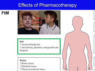 Effects of Pharmacotherapy
FtM
 