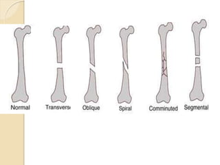 Geneal Principle of fracture | PPTX