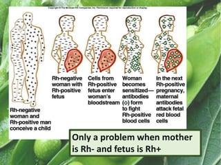 Only a problem when mother
is Rh- and fetus is Rh+
 