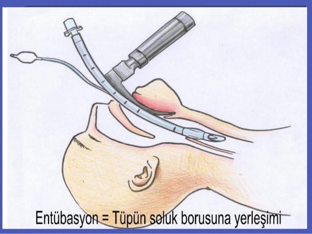 entübasyon nedir ?