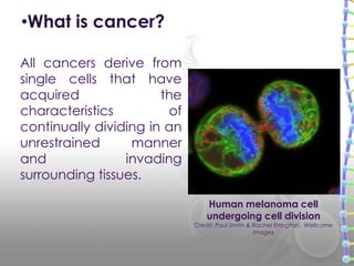 All cancers derive from
single cells that have
acquired the
characteristics of
continually dividing in an
unrestrained manner
and invading
surrounding tissues.
•What is cancer?
Human melanoma cell
undergoing cell division
Credit: Paul Smith & Rachel Errington, Wellcome
Images
 