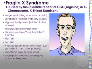 • Large, protruding ears (one or both)
• Long face (vertical maxillary excess)
• High-arched palate (related to the
above)
• Hyperextensible finger joints
• Hyperextensible ('Double-jointed')
thumbs
• Flat feet
• Soft skin
• Postpubescent macroorchidism (Lar
ge testes in men after puberty)
• Hypotonia (low muscle tone)
• single palm crease (crease goes
across entire palm)
•Fragile X Syndrome
Caused by trinucleotide repeat of CGG(Arginine) in X-
Chromosome. X-linked Dominant.
 