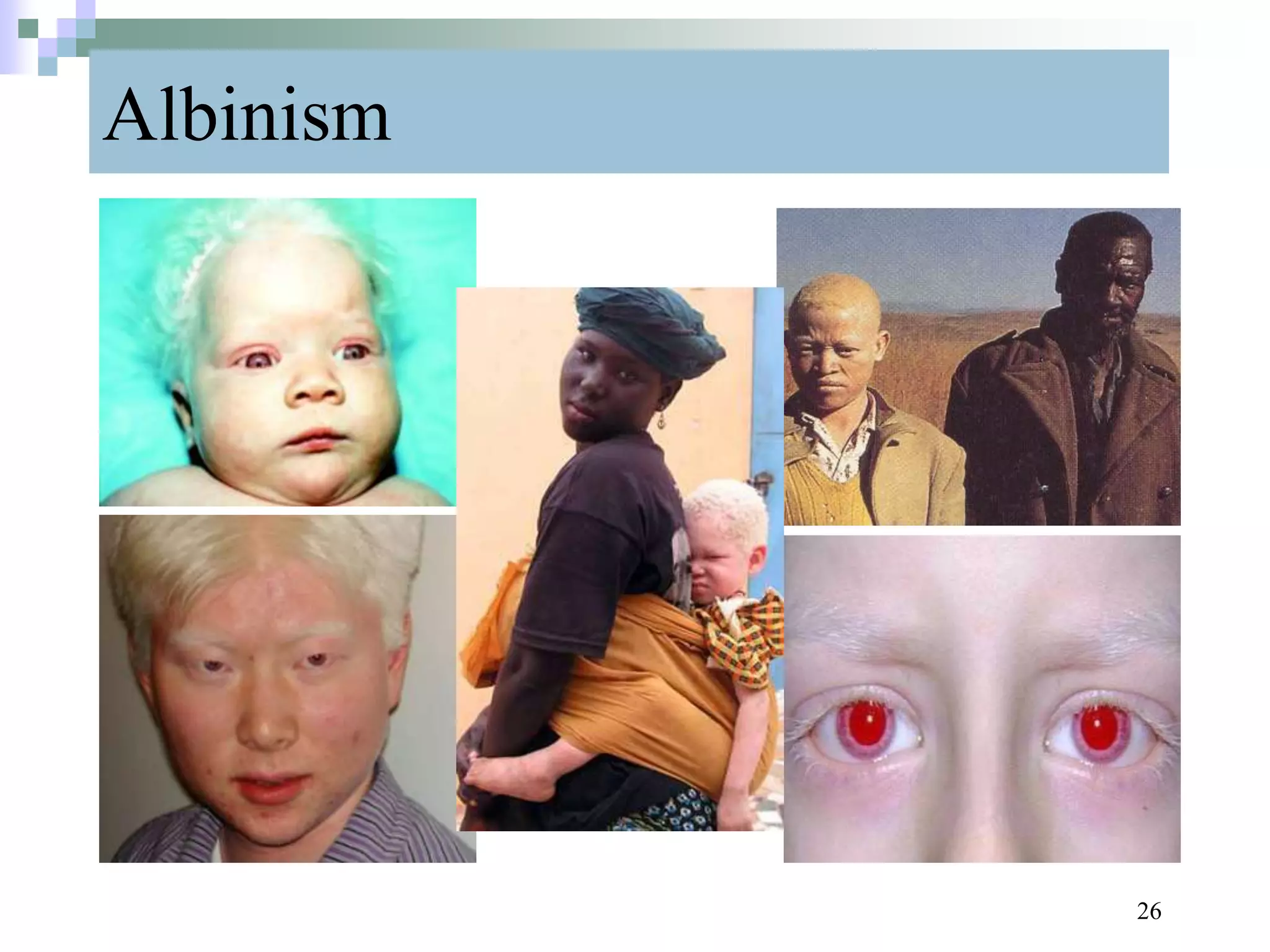 Albinism
26
 