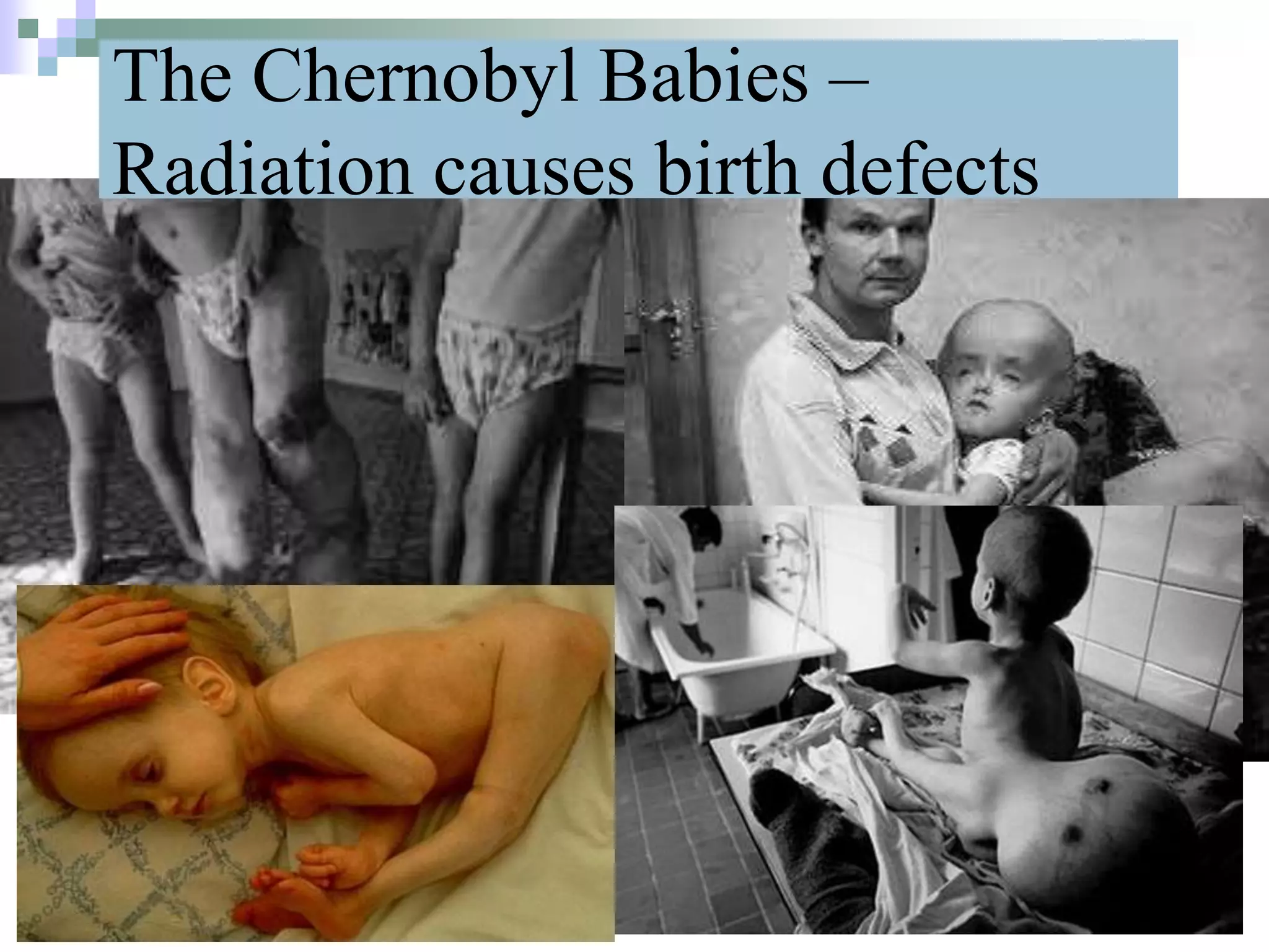 The Chernobyl Babies –
Radiation causes birth defects
32
 