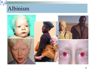 Albinism
26
 