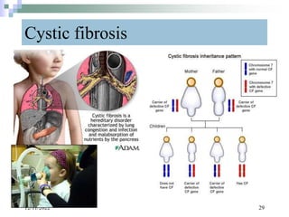Cystic fibrosis
12/11/2022 29
 