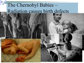 The Chernobyl Babies –
Radiation causes birth defects
32
 