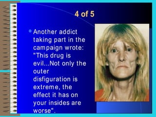 4 of 5
Another addict
taking part in the
campaign wrote:
"This drug is
evil...Not only the
outer
disfiguration is
extreme, the
effect it has on
your insides are
worse".
 