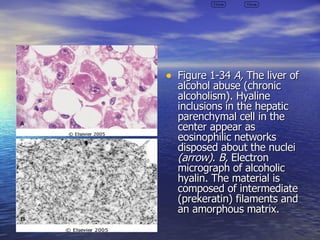 Hyaline Inclusions General Pathology Review | PPT