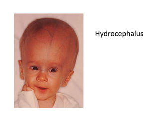 Hydrocephalus
 