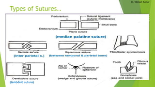Dr. Vibhash Kumar
Types of Sutures..
(lambdoid suture)
 