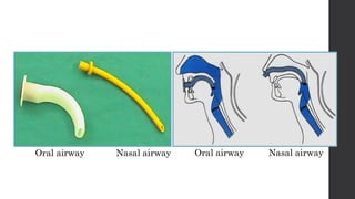 Oral airway Nasal airway Oral airway Nasal airway
 