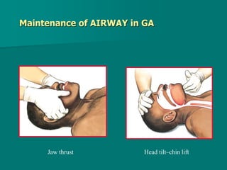 Maintenance of AIRWAY in GA
Jaw thrust Head tilt–chin lift
 