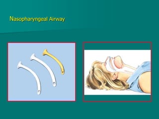 Nasopharyngeal Airway
 