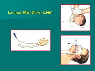 Laryngeal Mask Airway (LMA)
 