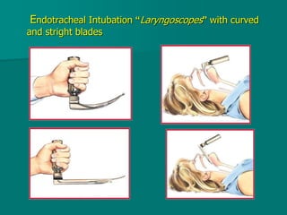 Endotracheal Intubation “Laryngoscopes” with curved
and stright blades
 