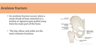 Avulsion fracture
• An avulsion fracture occurs when a
small chunk of bone attached to a
tendon or ligament gets pulled away
from the main part of the bone.
• The hip, elbow and ankle are the
most common locations
 
