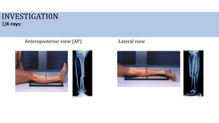 INVESTIGATI0N
1)X-rays:
Anteroposterior view (AP) Lateral view
 