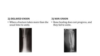 2) DELAYED UNION
• When a fracture takes more than the
usual time to unite.
3) NON-UNION
• Bone healing does not progress, and
they fail to unite.
 