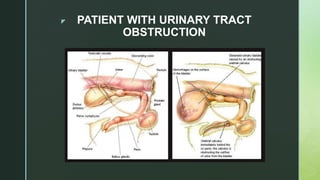 z PATIENT WITH URINARY TRACT
OBSTRUCTION
 