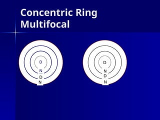 Multifocal Power Rings Comprehensive Overview of Contact Lenses: History, Types, and Optical ...