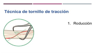 GENERALDADES TORNILLERIA 3.5.pptx