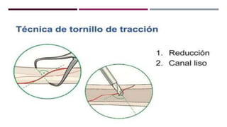 GENERALDADES TORNILLERIA 3.5.pptx