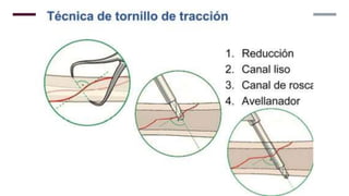 GENERALDADES TORNILLERIA 3.5.pptx