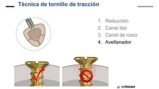 GENERALDADES TORNILLERIA 3.5.pptx