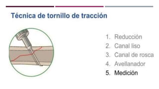 GENERALDADES TORNILLERIA 3.5.pptx