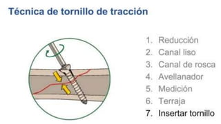 GENERALDADES TORNILLERIA 3.5.pptx