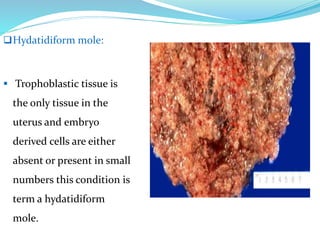 Hydatidiform mole:
 Trophoblastic tissue is
the only tissue in the
uterus and embryo
derived cells are either
absent or present in small
numbers this condition is
term a hydatidiform
mole.
 
