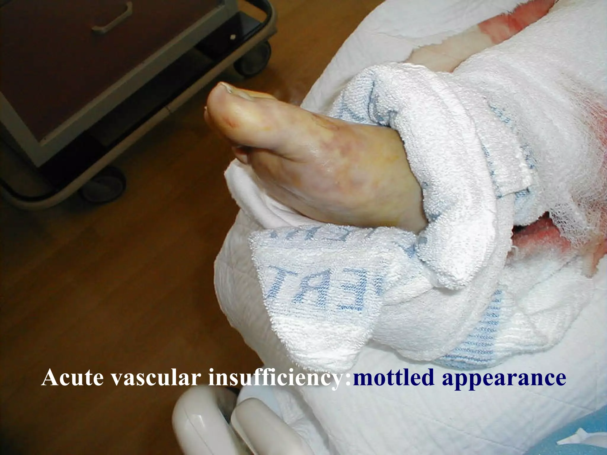 Acute vascular insufficiency: mottled appearance 