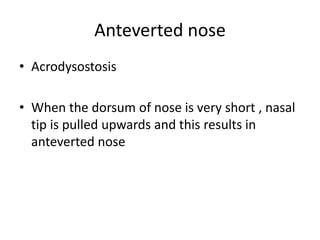 Anteverted nose
• Acrodysostosis
• When the dorsum of nose is very short , nasal
tip is pulled upwards and this results in
anteverted nose
 