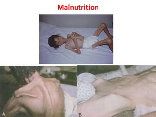 Malnutrition
 