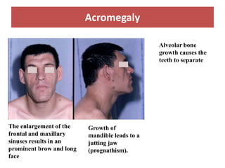 Acromegaly
The enlargement of the
frontal and maxillary
sinuses results in an
prominent brow and long
face
Growth of
mandible leads to a
jutting jaw
(prognathism).
Alveolar bone
growth causes the
teeth to separate
 