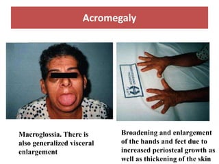 Acromegaly
Macroglossia. There is
also generalized visceral
enlargement
Broadening and enlargement
of the hands and feet due to
increased periosteal growth as
well as thickening of the skin
 