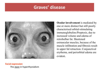 Graves’ disease
Ocular involvement is mediated by
one or more distinct but still poorly
characterised orbital-stimulating
immunoglobulins:Proptosis, due to
increased volume and edema of
retrobulbar fat. Shortened
extraocular muscles, because of the
muscle infiltration and fibrosis result
in upper lid retraction. Conjunctival
erythema, and periorbital edema are
evident.
Facial expression
The stare in hyperthyroidism
 