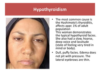 Hypothyroidism
• The most common cause is
the Hashimoto’s thyroiditis,
affects appr. 1% of adult
population
This woman demonstrates
the typical hypothyroid facies.
She also had a slow, hoarse,
deep voice and lassitude
(state of feeling very tired in
mind or body).
• Dull, puffy facies. Edema does
not pit with pressure. The
lateral eyebrows are thin.
 