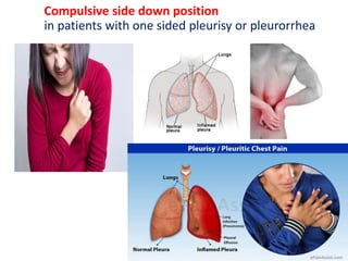 Compulsive side down position
in patients with one sided pleurisy or pleurorrhea
 