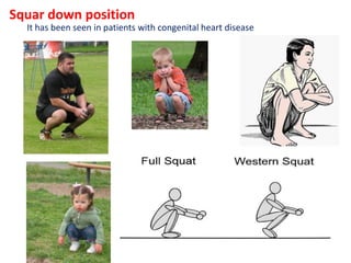 Squar down position
It has been seen in patients with congenital heart disease
 