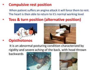 • Compulsive rest position
When patient suffers an angina attack it will force them to rest.
The heart is then able to return to it’s normal working level
• Toss & turn position (alternative position)
• Opisthotonos
It is an abnormal posturing condition characterized by
rigidity and severe aching of the back, with head thrown
backwards
 