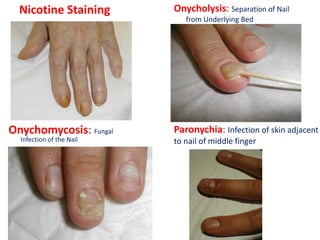 Nicotine Staining Onycholysis: Separation of Nail
from Underlying Bed
Onychomycosis: Fungal
Infection of the Nail
Paronychia: Infection of skin adjacent
to nail of middle finger
 