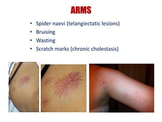 ARMS
• Spider naevi (telangiectatic lesions)
• Bruising
• Wasting
• Scratch marks (chronic cholestasis)
 