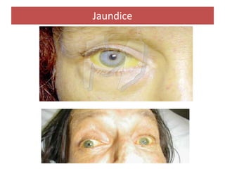 Jaundice
 