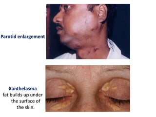 Parotid enlargement
Xanthelasma
fat builds up under
the surface of
the skin.
 