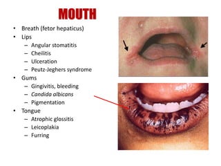 MOUTH
• Breath (fetor hepaticus)
• Lips
– Angular stomatitis
– Cheilitis
– Ulceration
– Peutz-Jeghers syndrome
• Gums
– Gingivitis, bleeding
– Candida albicans
– Pigmentation
• Tongue
– Atrophic glossitis
– Leicoplakia
– Furring
 