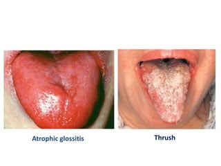 Atrophic glossitis Thrush
 